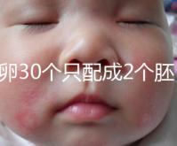 取卵30個只配成2個胚胎別放棄！卵巢傷口小移植成功率不低
