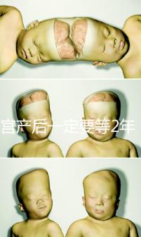 剖宮產后一定要等2年,才能試管嬰兒懷孕嗎?