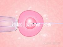 時間短、操作簡單,分步驟解讀宮頸擴張術全過程